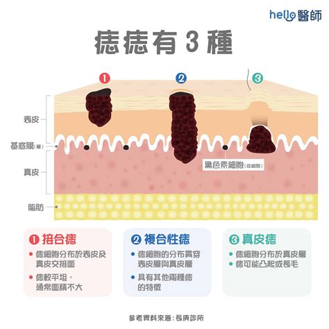 陰莖長黑痣|痣形成的原因？痣長毛、痣變多變大是痣病變？5招判別